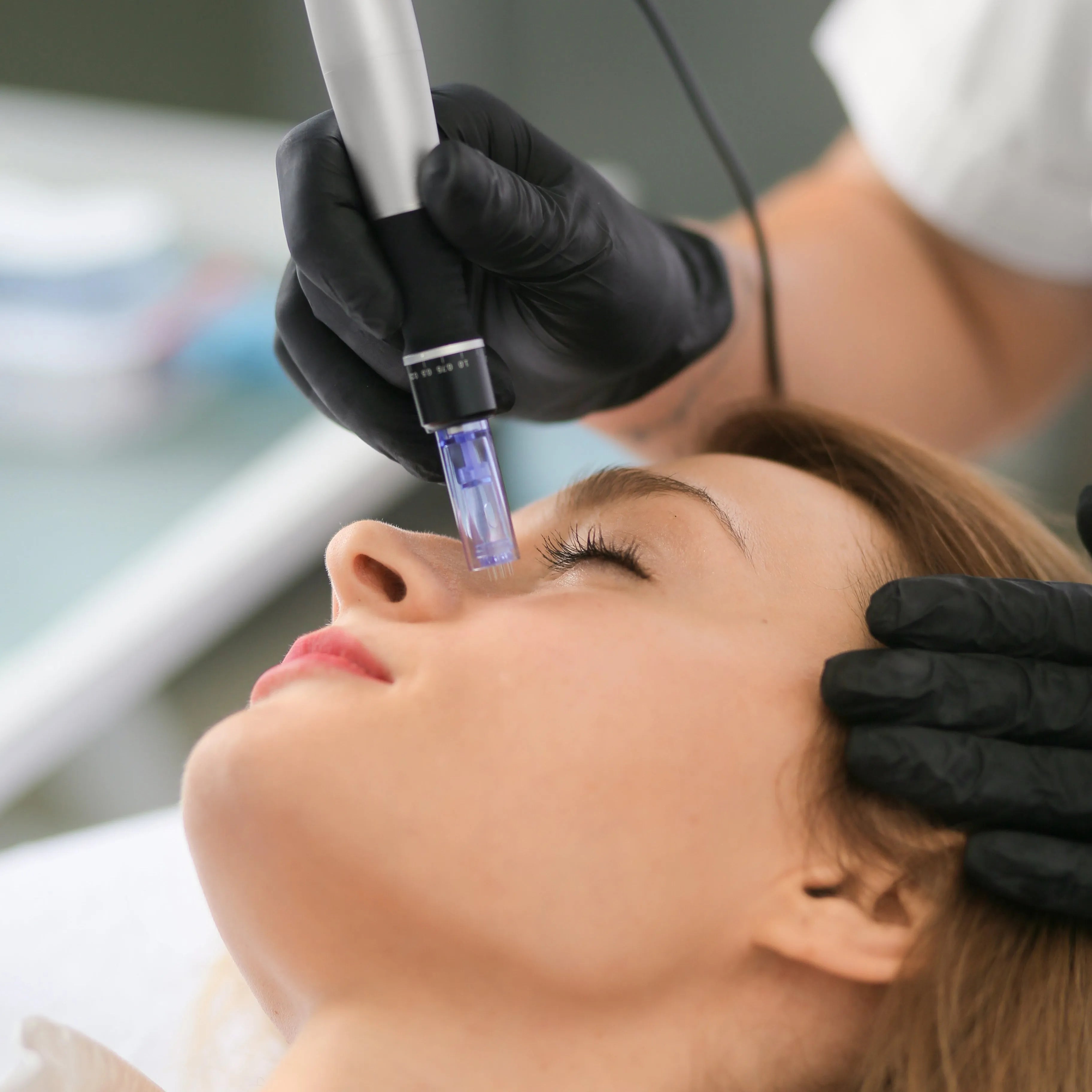 Totalne odmłodzenie: Biostymulacja chemiczna z mikronakłuwaniem twarzy, szyi i dekoltu